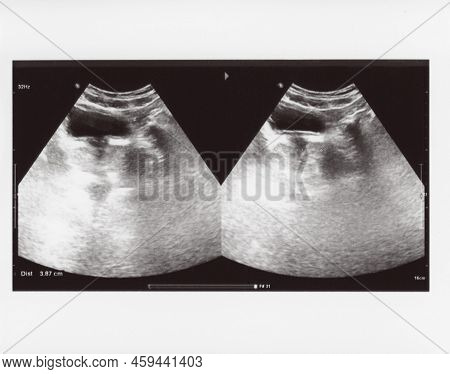 Full Abdomen Ultrasound Sonogram