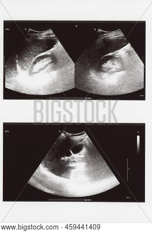 Full Abdomen Ultrasound Sonogram