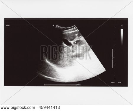 Full Abdomen Ultrasound Sonogram