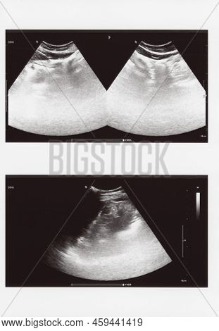 Full Abdomen Ultrasound Image Aka Diagnostic Sonogram