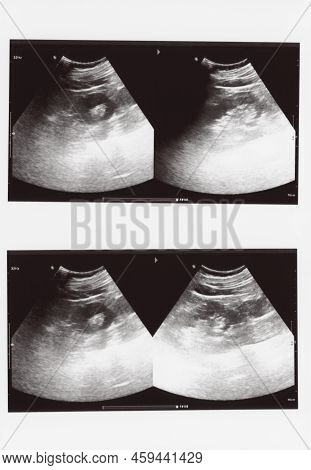 Full Abdomen Ultrasound Image Aka Diagnostic Sonogram