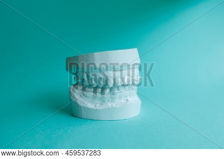 Plaster Mould Of Human Jaw With Transparent Aligner, Invisible Retainer Or Orthodontic Silicone Trai