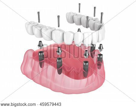 3D Render Of Mandibular Prosthesis All-on-6 System Supported By Implants
