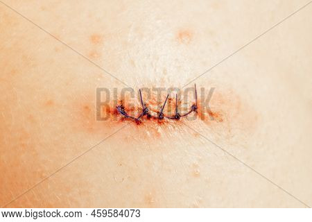 Stitched Wound And Medical Suture, Close-up. Medical Sutures After Operations, Sewn Surgical Sutures
