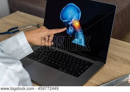 Doctor Showing A X-ray Of Pain In The Neck. Migraine Headache And Backache.