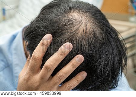 Bald In The Middle Head And Begin No Loss Hair Glabrous Of Mature Asian Business Smart Active Office