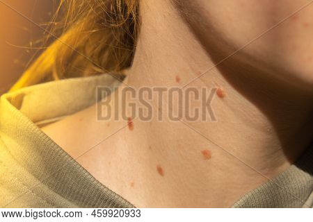 Birthmarks On Skin Close Up Detail Of The Bare Skin Sun Exposure Effect On Skin, Health Effects Of U