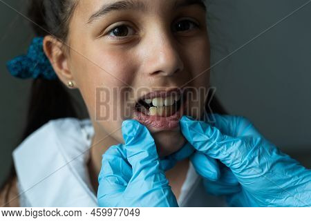 Dentist Is Check And Set Dimension Of Brackets. Talking To Girl About Braces In Her Mouth