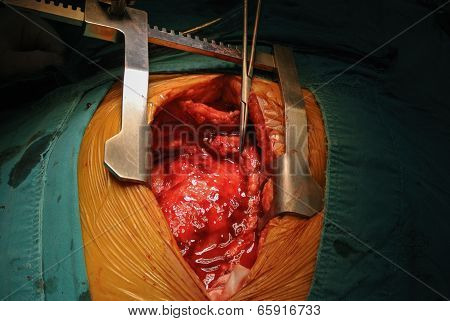 Cardiac Tumor