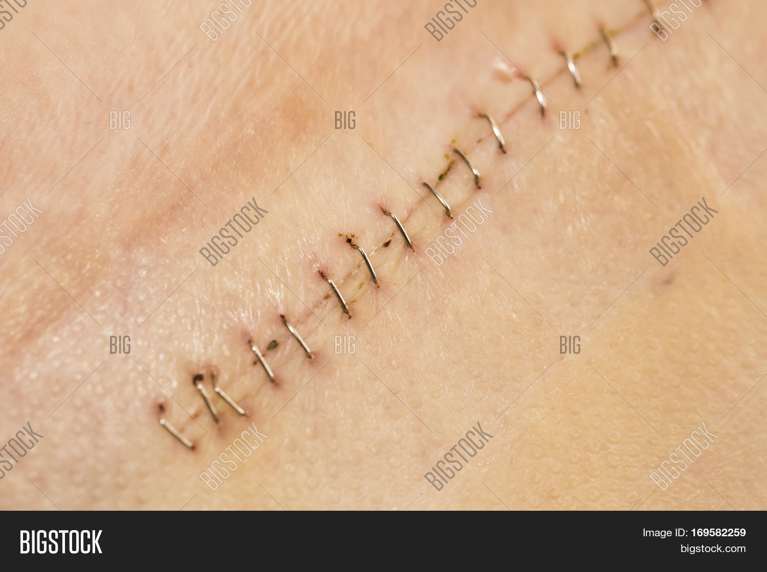 Long Scar Staples Image & Photo (Free Trial) Bigstock