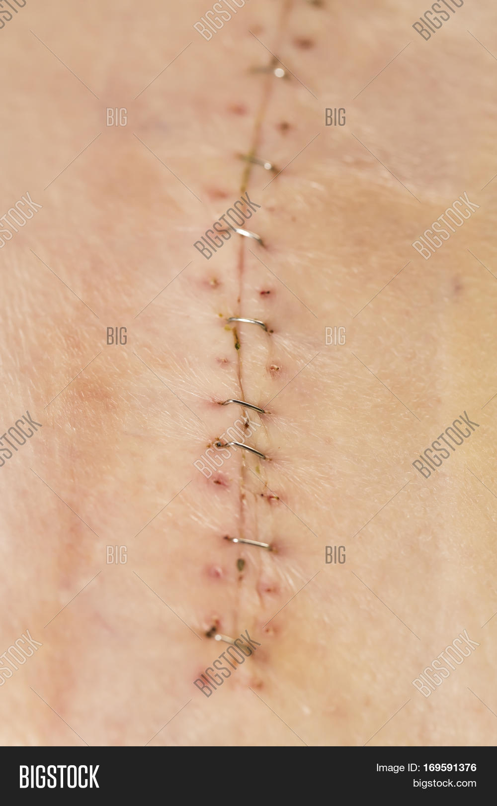 Long Scar Staples Image & Photo (Free Trial) Bigstock