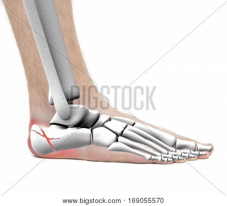 Calcaneus Fracture - Anatomy Male - Studio Photo Isolated On White
