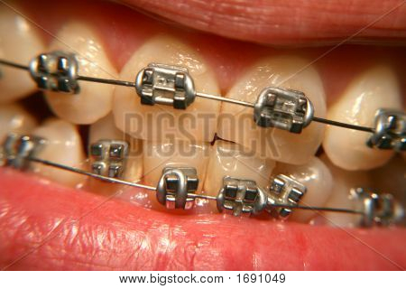Dental Klammern