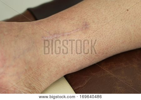 Old Human Leg With Postoperative Scar Of Cardiac Surgery. Heart Disease. Medical Concept