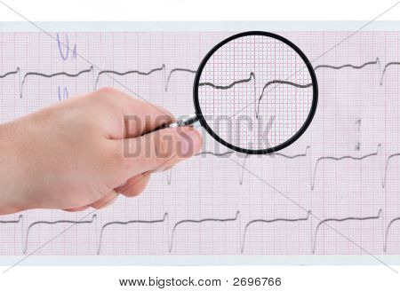 Ecg 인쇄물에 좀 더 가까이