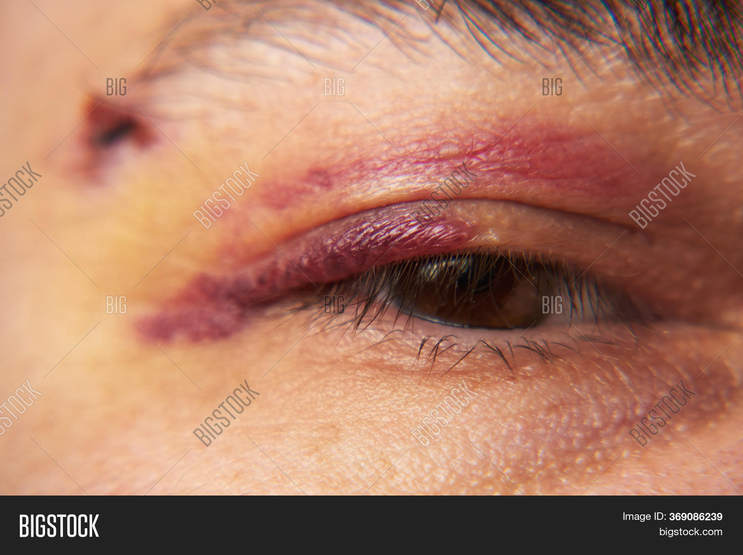 Close View Bruise Near Image & Photo (Free Trial) Bigstock
