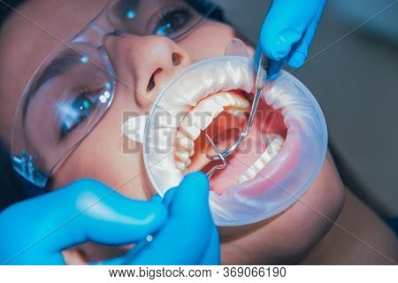 Dental Treatment With Expander. Modern Medical Technology