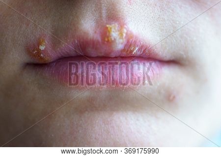 Herpes Disease On The Lips Of A Young Girl. Wounds From Herpes On The Lips Of A Person. Herpes Foci.