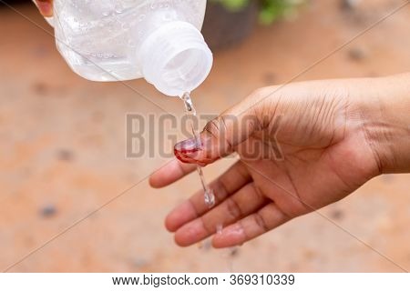 The Saline Solution Is Poured Over The Human Finger With Black Nails, Bruised With Blood.
