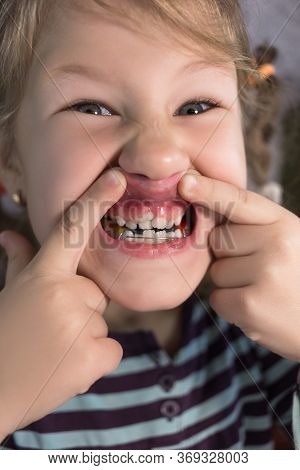 Adult Permanent Teeth Coming In Front Of The Child's Baby Teeth: Shark Teeth. Little Girl's Open Mou