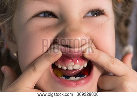 Adult Permanent Teeth Coming In Front Of The Child's Baby Teeth: Shark Teeth. Little Girl's Open Mou
