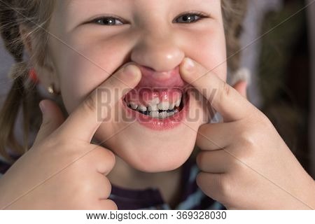 Adult Permanent Teeth Coming In Front Of The Child's Baby Teeth: Shark Teeth. Little Girl's Open Mou