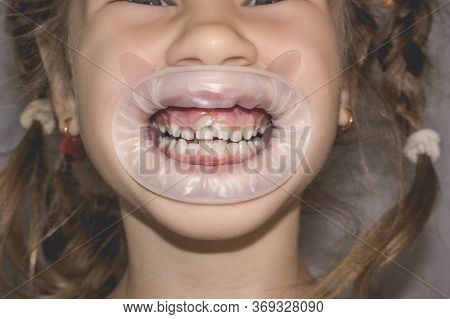 Adult Permanent Teeth Coming In Front Of The Child's Baby Teeth: Shark Teeth. Little Girl's Open Mou