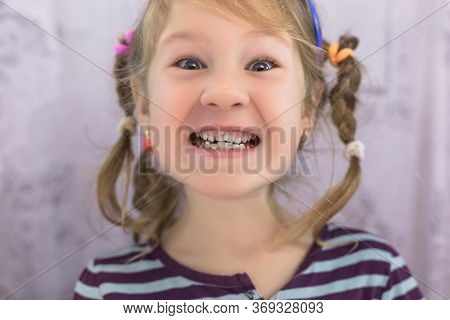 Adult Permanent Teeth Coming In Front Of The Child's Baby Teeth: Shark Teeth. Little Girl's Open Mou