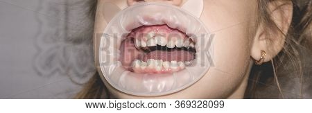 Adult Permanent Teeth Coming In Front Of The Child's Baby Teeth: Shark Teeth. Little Girl's Open Mou