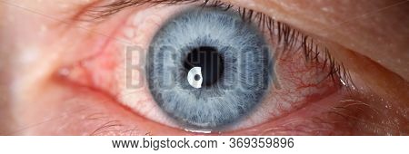 Irritated Left Blue Male Eye Full With Red Capillar Net Close-up