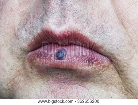 Venous Lake Of The Lower Lip Of Mouth. Healthcare And Medical Concept.