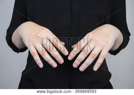 Woman Suffers From Pain In Fingers. Arthritis Or Arthrosis, Cartilage Wear, Rheumatism Of The Joints