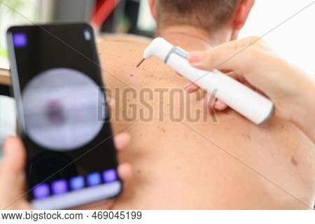 Beautician Making Skin Electrocautery For Male Patient. Doctor Cosmetologist Removing Mole And Pigme