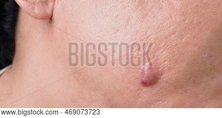 Big Acne Cyst Abscess Or Ulcer Swollen Area Within Face Skin Tissue.