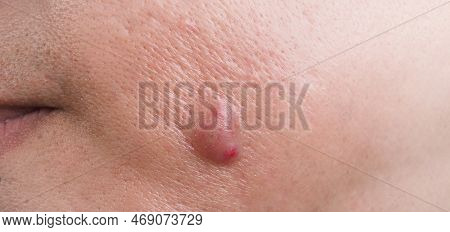 Big Acne Cyst Abscess Or Ulcer Swollen Area Within Face Skin Tissue.