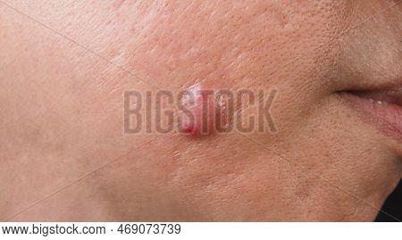 Big Acne Cyst Abscess Or Ulcer Swollen Area Within Face Skin Tissue.