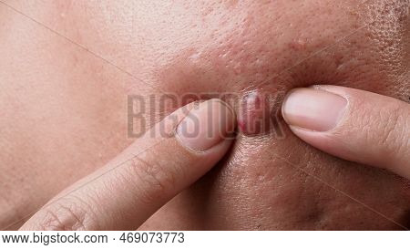 Big Acne Cyst Abscess Or Ulcer Swollen Area Within Face Skin Tissue.