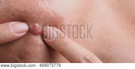 Big Acne Cyst Abscess Or Ulcer Swollen Area Within Face Skin Tissue.