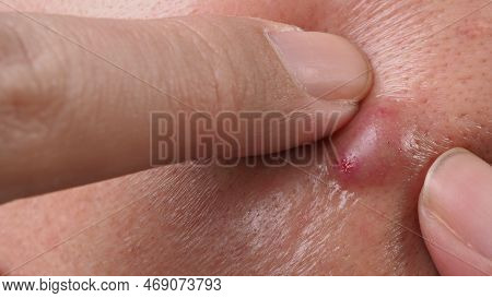 Big Acne Cyst Abscess Or Ulcer Swollen Area Within Face Skin Tissue.