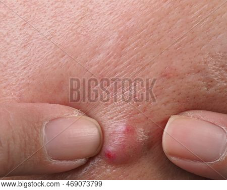 Big Acne Cyst Abscess Or Ulcer Swollen Area Within Face Skin Tissue.