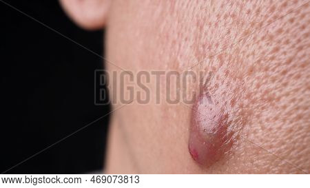 Big Acne Cyst Abscess Or Ulcer Swollen Area Within Face Skin Tissue.