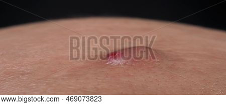 Big Acne Cyst Abscess Or Ulcer Swollen Area Within Face Skin Tissue.