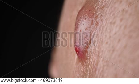 Big Acne Cyst Abscess Or Ulcer Swollen Area Within Face Skin Tissue.