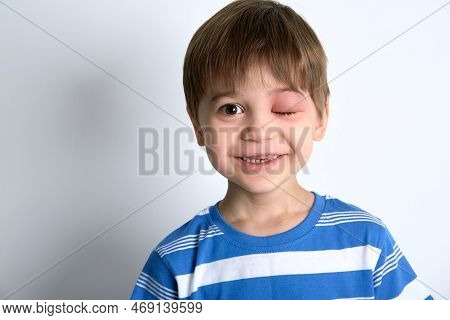 A Boy With Swollen Eye From Insect Bite. Quincke Edema. Portrait Of Caucasian Appearance Child Looki