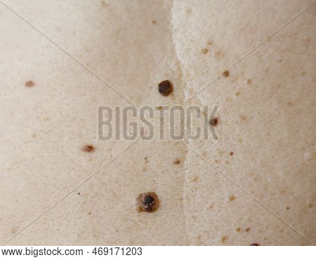 Image Of Part A Woman's Back With Melanoma And Seborrheic Keratosis