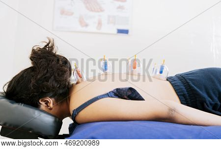 Acupuncture Cupping On The Back Of A Person Lying Down, Patient Lying Down With Suction Cups On Her 