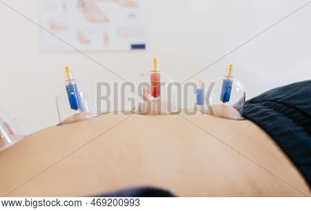 Close-up Of Suction Cups On The Patient Back, Acupuncture Cupping On The Back Of A Person Lying Down