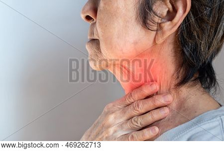 Redness At The Neck Of Asian, Myanmar Woman. Concept Of Sore Throat, Pharyngitis, Laryngitis, Esopha