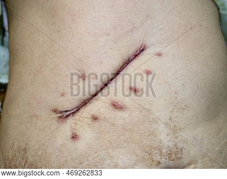 Scar Of Kocher's Incision At Abdomen Of The Elder Woman.