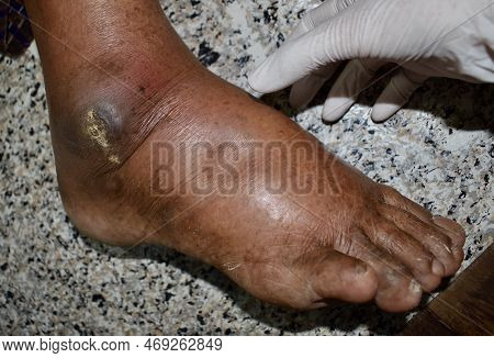 Pitting Edema Of Lower Limb. Swollen Leg Of Asian Old Man.